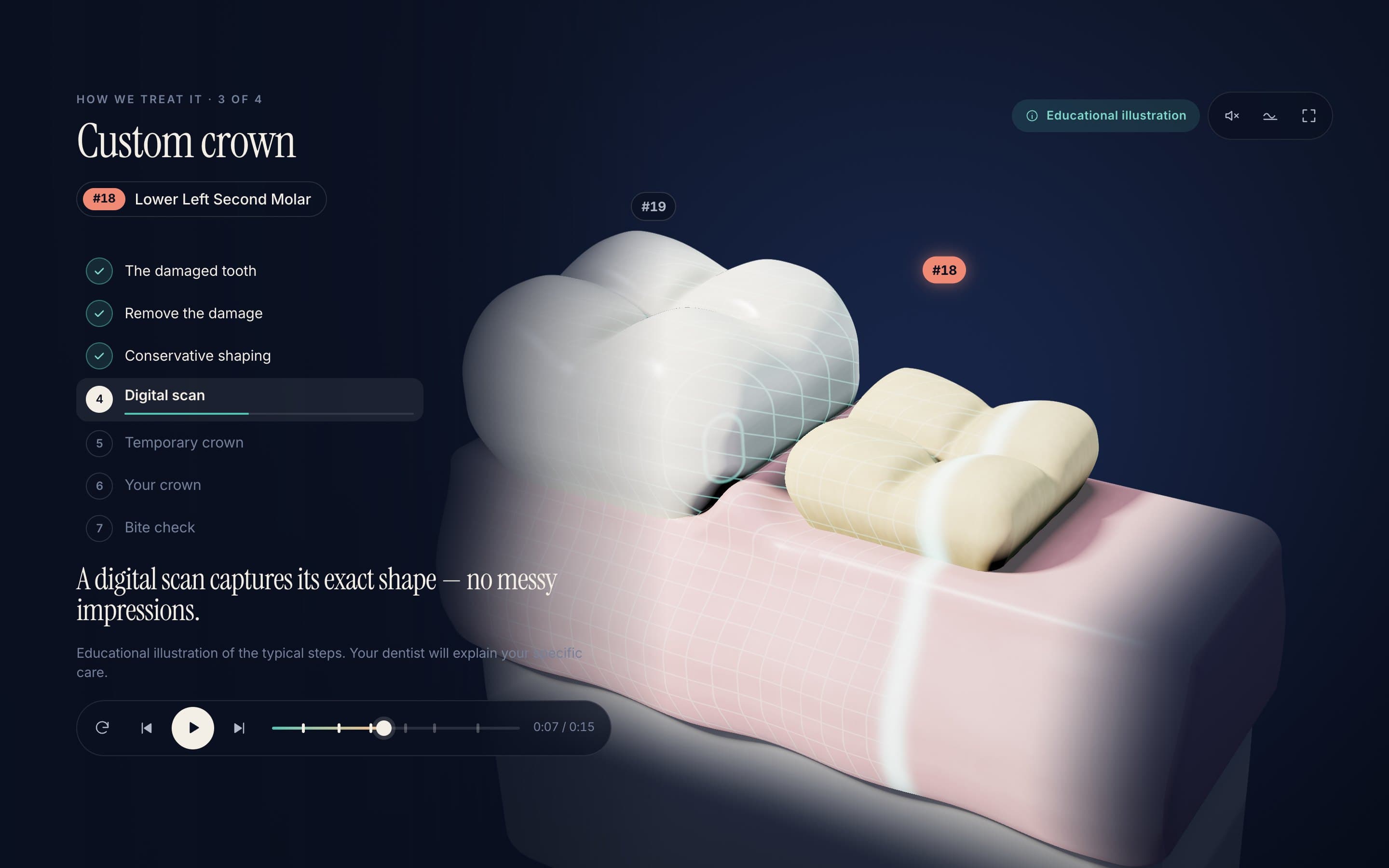 Digital scan — The prepared tooth is captured before the custom crown is made.